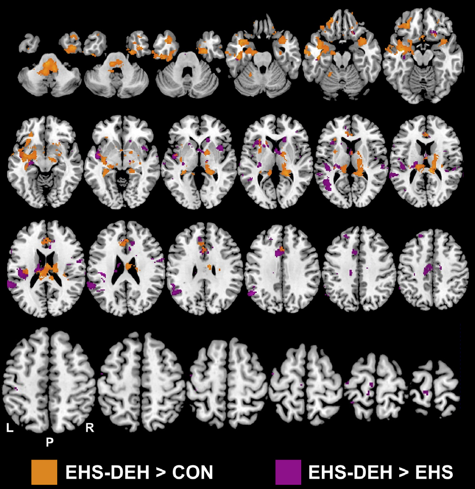 fMRI brain activity in dehydration