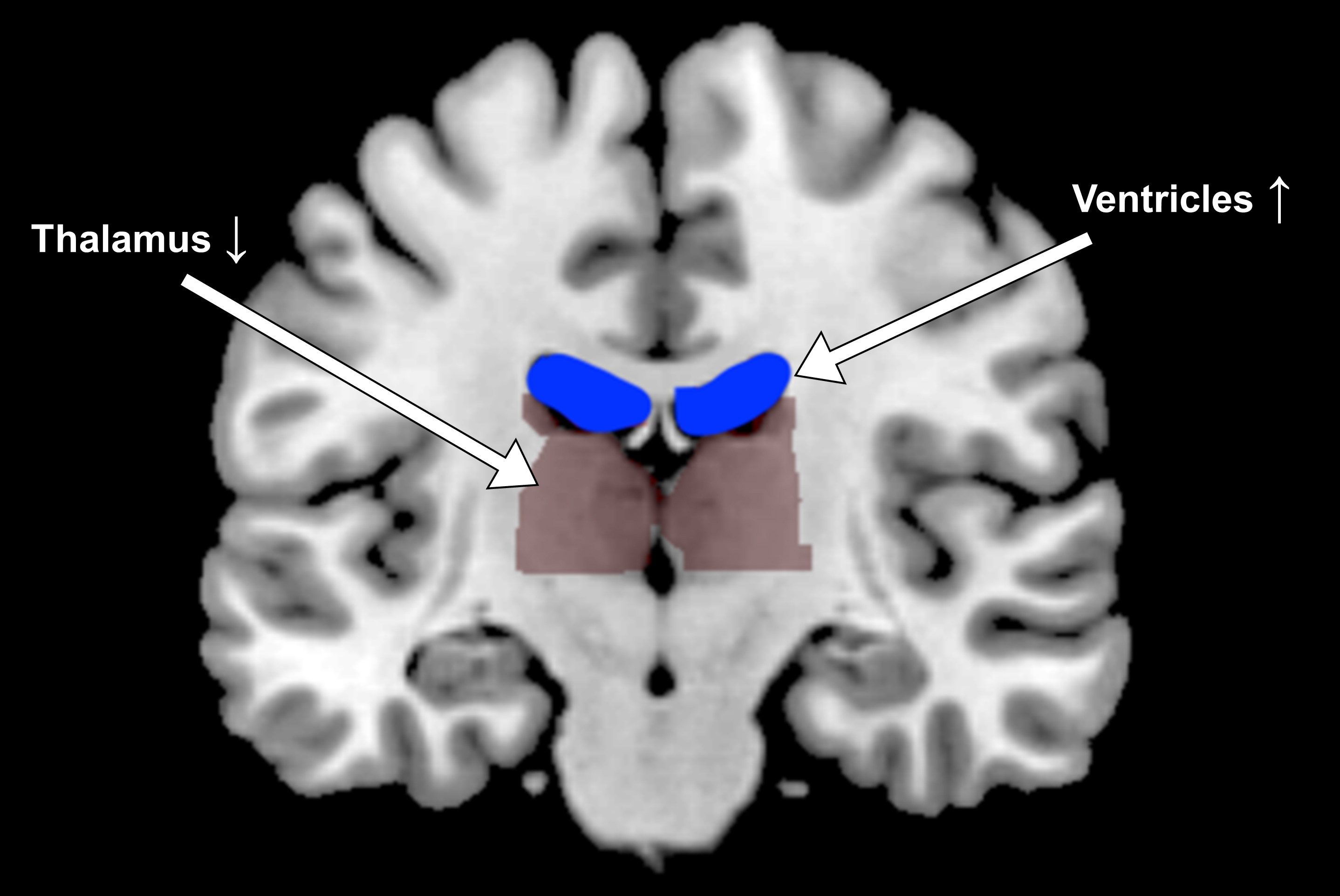 fMRI brain ventricles expand in dehydration