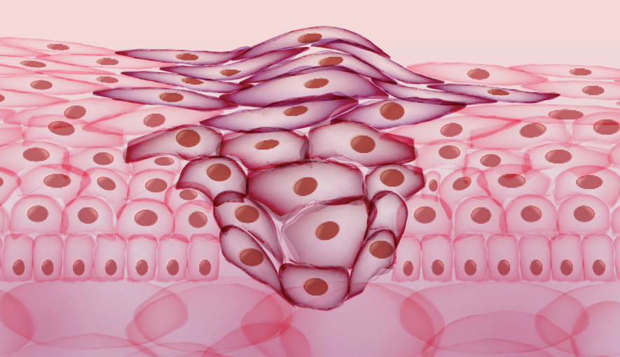 iStock cancer cells illustration