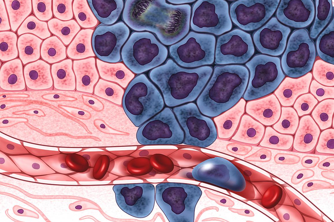 Growing cancer cells (purple) are surrounded by healthy cells (pink), illustrating a primary tumor spreading to other parts of the body via the circulatory system. (Image courtesy Darryl Leja, NHGRI)