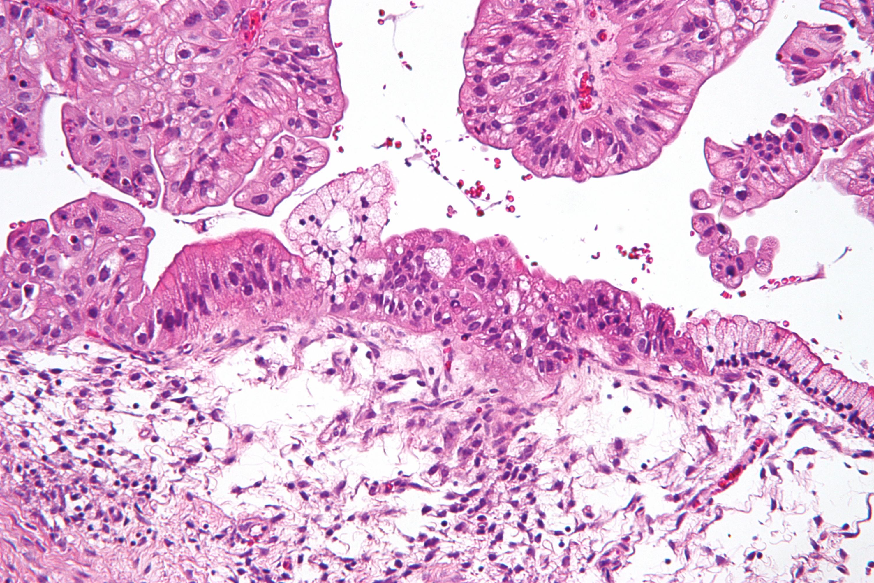 Ovarian cancer cells (Photo Nephron via Wikimedia Commons)