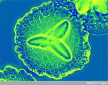 Periodontitis culprit Aggregatibacter actinomycetemcomitans by CC Periodontitis culprit Aggregatibacter actinomycetemcomitans by CC