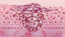 iStock cancer cells illustration iStock cancer cells illustration