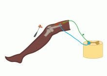Tendon Tap Tendon Tap