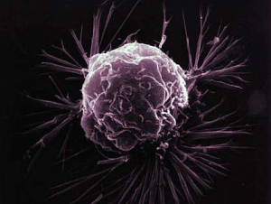 Closeup image of a breast cancer cell. (Photo courtesy National Cancer Institute)