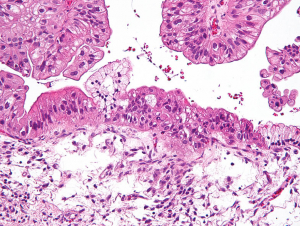 Micrograph of a mucinous ovarian tumor (Photo National Institutes of Health)