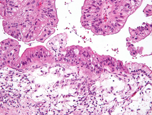 Ovarian cancer cells (Photo Nephron via Wikimedia Commons)